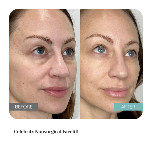 Before and after treatment result — Dr. Lanna, LC Medical Aesthetics NYC